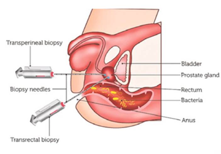 Additional Measures Prior to Prostate Biopsy