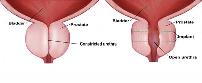 UroLift procedure for enlarged prostate, using two implants to relieve urethra obstruction